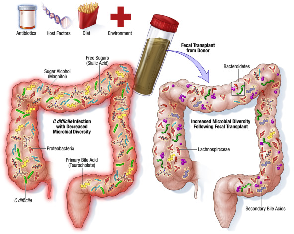 Fecal Transplant